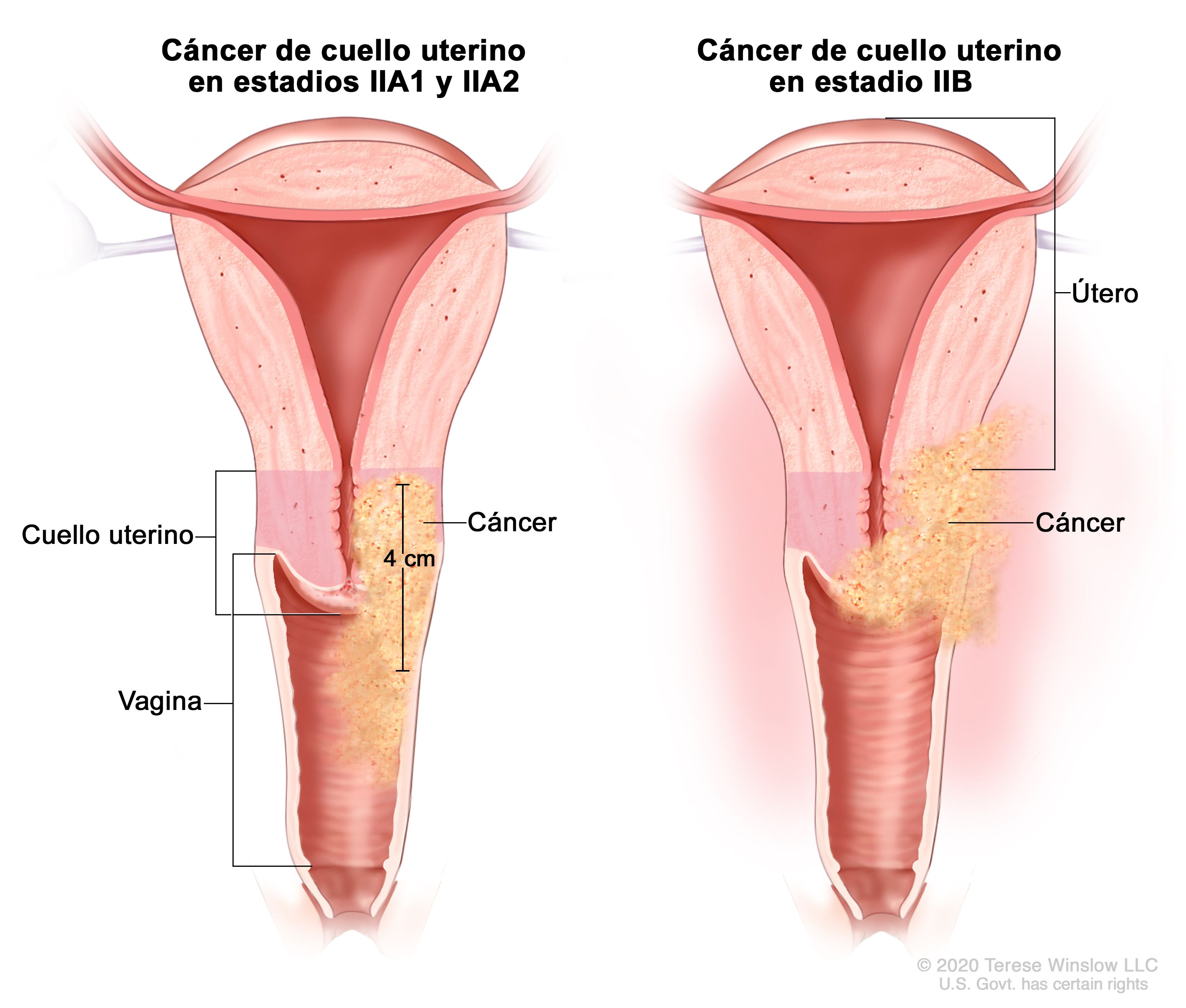 Los cánceres de Cuello Uterino, Mama y Próstata son los que más afectan a la población boliviana